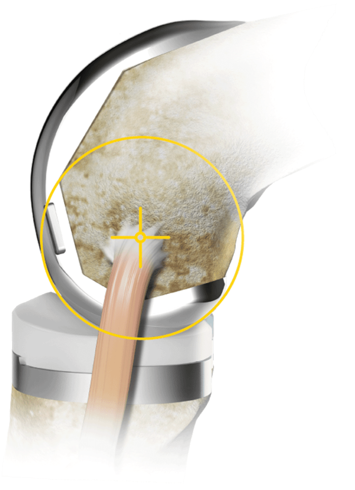 Triathlon knee replacement